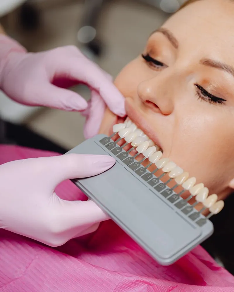 A escala de cores dos dentes encostada ao sorriso de uma paciente